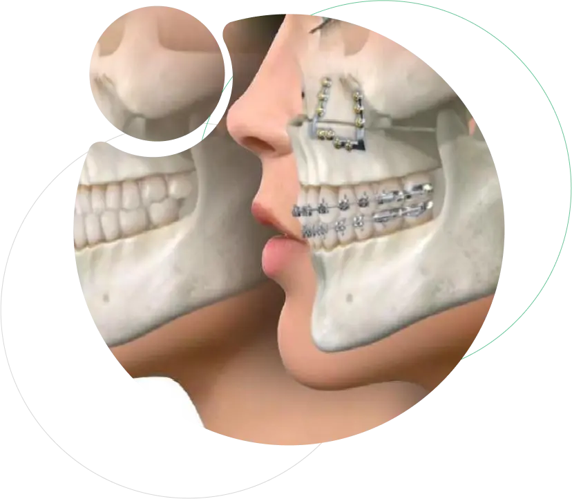 Jaw Deformity Correction Jaw Deformity Correction