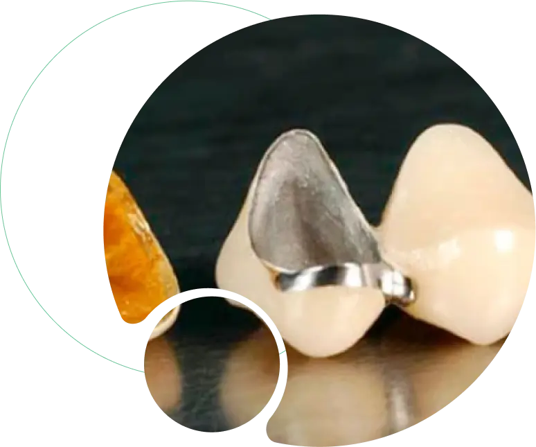 PFM Crowns and Bridges PFM Crowns and Bridges